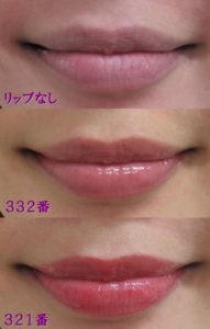 しばこ唇拡大
