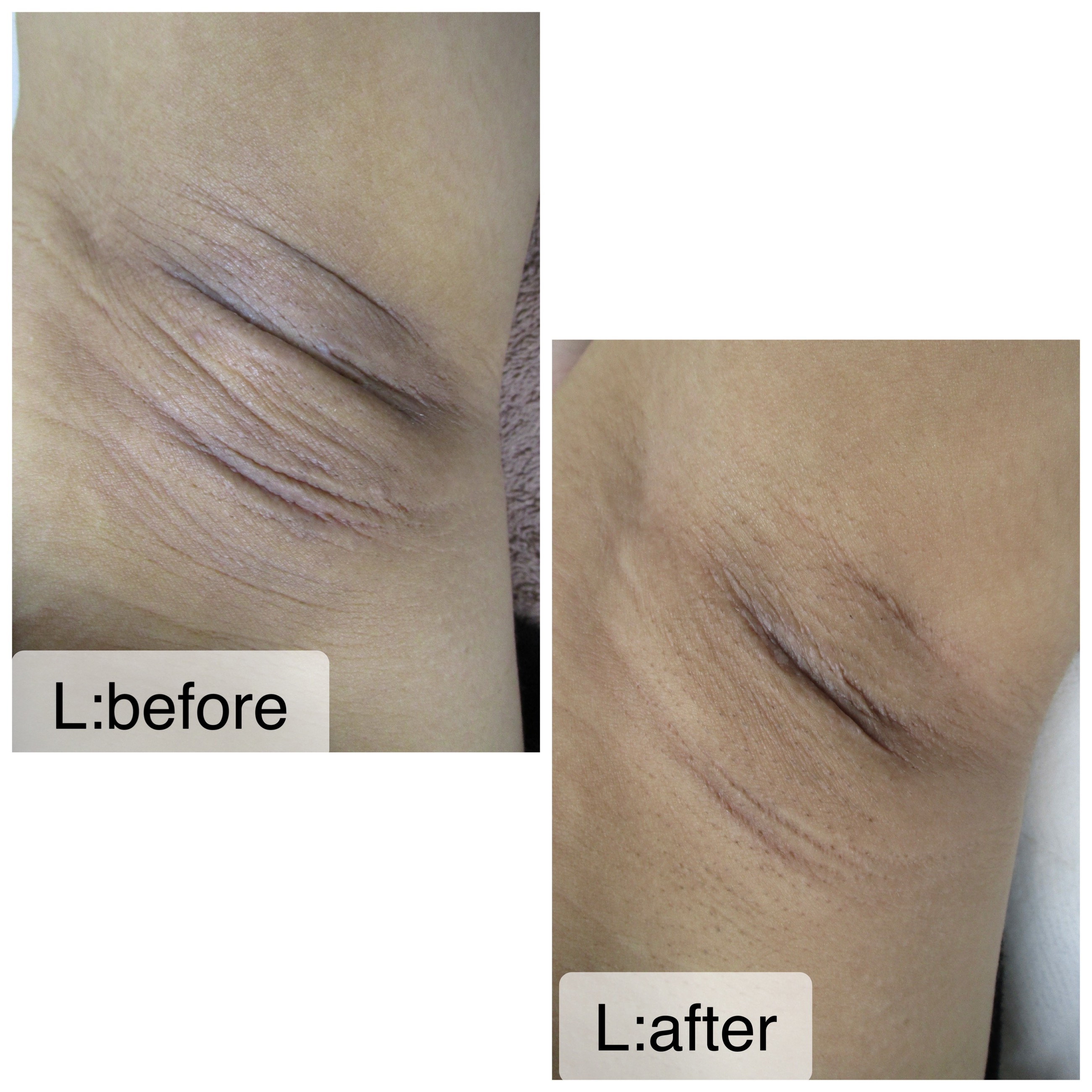 ミラノリピール (Bio Re Peel Cl3)の症例写真