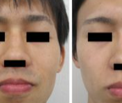 医療脱毛 (男性)の症例写真